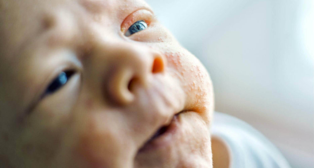 atopic-dermatitis-in-children