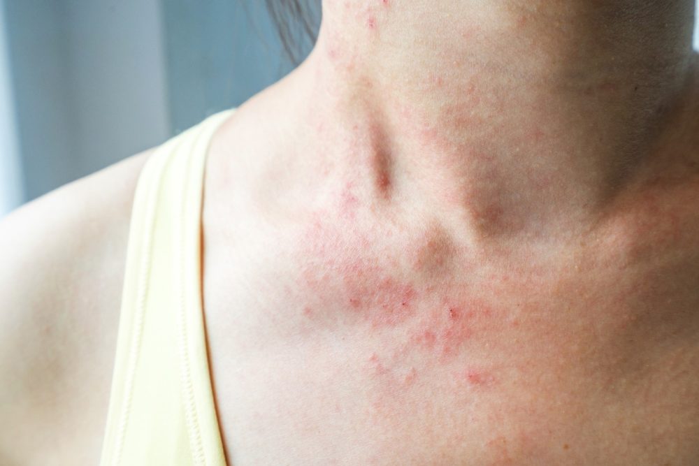 women rash neck